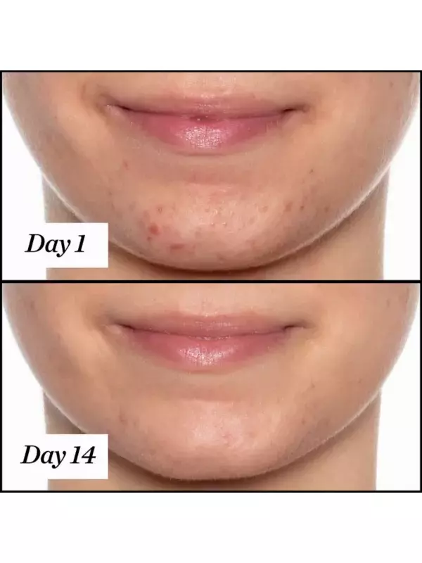 Ufo салициловая кислота bha лечение акне масло для лица Sunday Riley, объем 34 мл